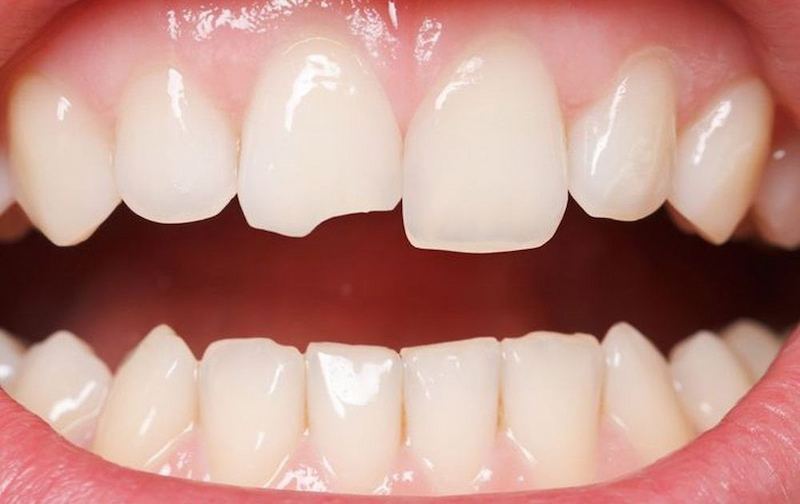 Giá bọc răng sứ Lava 3M bao nhiêu tiền? Yếu tố quyết định giá Răng sứt mẻ bọc sứ là lựa chọn phù hợp