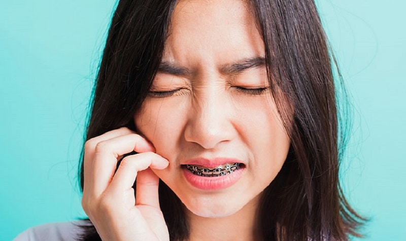 Niềng răng bị mỏi hàm có bình thường không? Bao lâu thì hết? Niềng răng bị mỏi hàm là hiện tượng bình thường