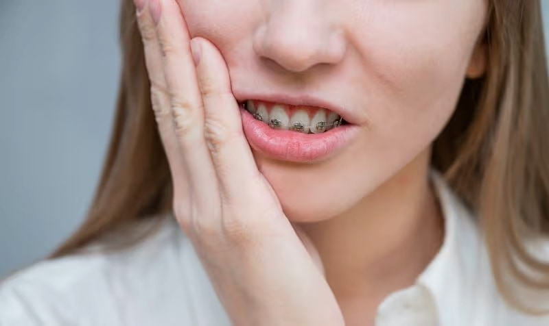 Niềng răng bị mỏi hàm có bình thường không? Bao lâu thì hết? Tình trạng mỏi hàm sau niềng răng có thể kéo dài 3 - 7 ngày