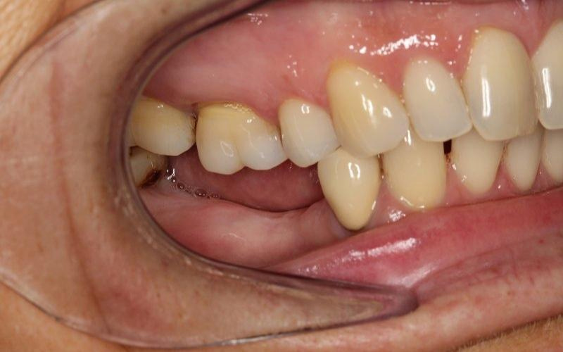 Niềng răng bị tiêu xương: Nguyên nhân và giải pháp khắc phục Niềng răng có nguy cơ tiêu xương trong một số trường hợp