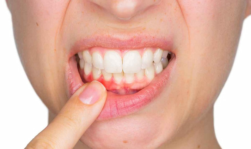 Niềng răng bị tiêu xương: Nguyên nhân và giải pháp khắc phục Những người mắc bệnh nha chu trước đó dễ bị tiêu xương khi niềng răng