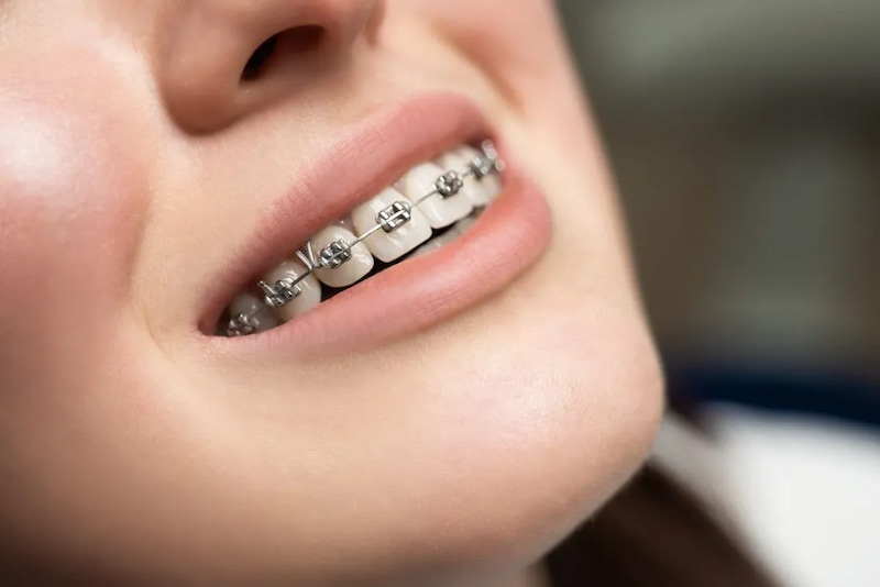 Niềng răng hay bọc sứ tốt hơn? Lưu ý trước khi quyết định Niềng răng là phương pháp thích hợp khi răng khấp khểnh, lệch lạc nghiêm trọng
