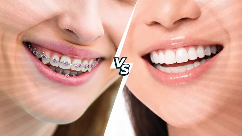 Niềng răng hay bọc sứ tốt hơn? Lưu ý trước khi quyết định Bạn cần lựa chọn phương pháp phù hợp với tình trạng răng miệng của mình
