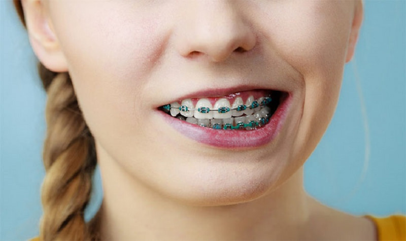 Niềng răng hỏng: Dấu hiệu nhận biết và cách xử lý kịp thời Niềng răng hỏng khiến mặt bị lệch