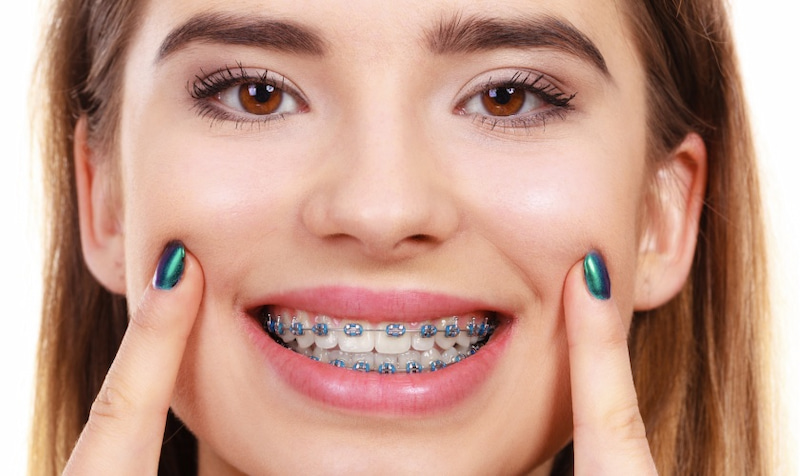 Niềng răng hỏng: Dấu hiệu nhận biết và cách xử lý kịp thời Niềng răng bị hỏng có thể phải niềng lại từ đầu