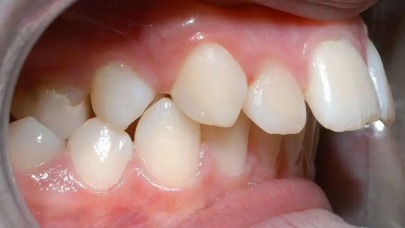 Răng hô nên niềng hay bọc sứ? So sánh 2 phương pháp Trường hợp răng hô nặng nên niềng để thu gọn cung hàm hiệu quả