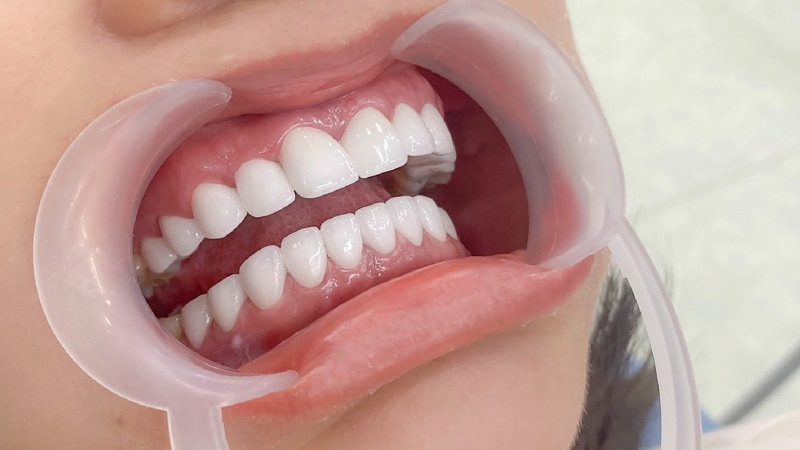 Răng lệch đường giữa: Dấu hiệu, nguyên nhân và cách khắc phục Bọc sứ là phương pháp chỉnh lệch đường giữa hiệu quả