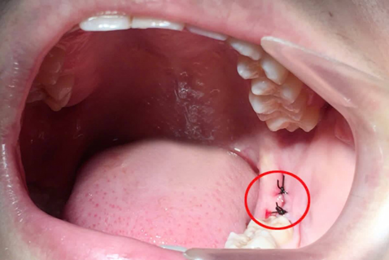 Vết khâu nhổ răng khôn bị hở: Nguyên nhân và cách xử lý Vết khâu nhổ răng khôn bị hở không nguy hiểm nếu kích thước nhỏ